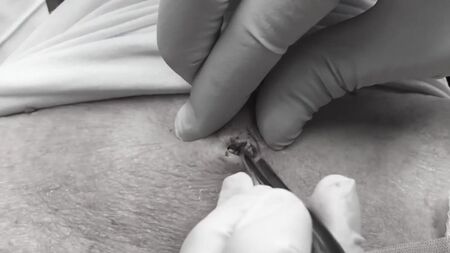 Le Dr Lee enlève un point noir ÉNORME Dr Sandra Lee Spécialiste de la peau Discovery HH_1080p